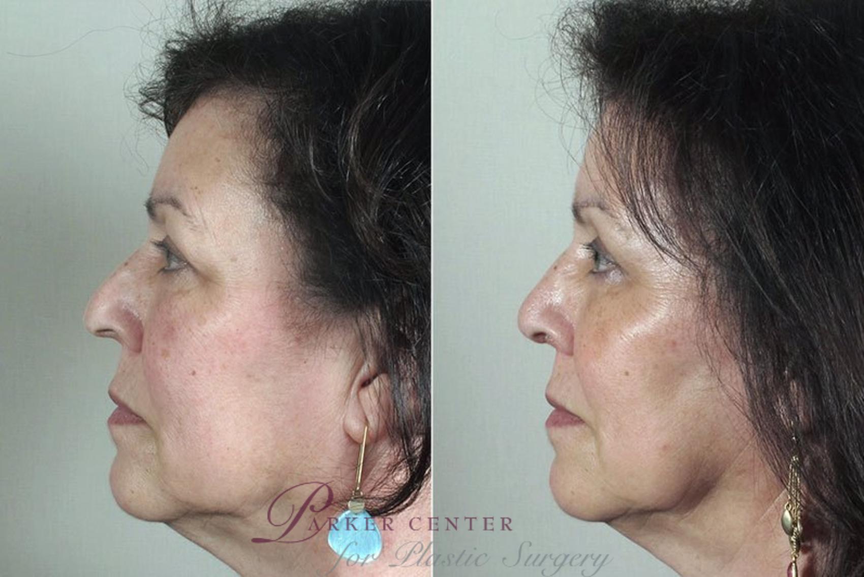 Rhinoplasty Case 174 Before & After View #2 | Paramus, NJ | Parker Center for Plastic Surgery