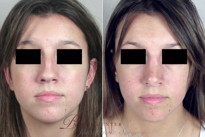 Rhinoplasty Case 175 Before & After View #1 | Paramus, NJ | Parker Center for Plastic Surgery