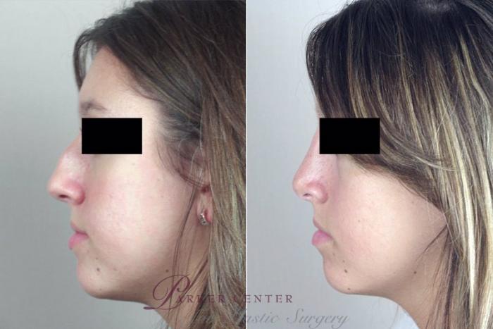 Rhinoplasty Case 175 Before & After View #2 | Paramus, NJ | Parker Center for Plastic Surgery
