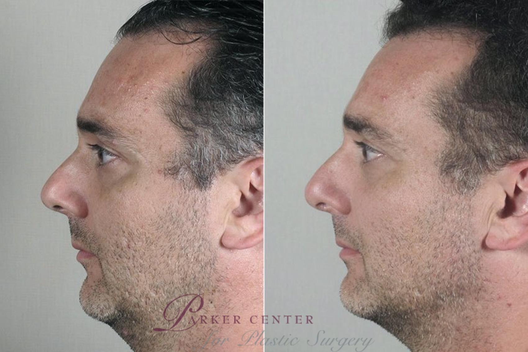 Rhinoplasty Case 176 Before & After View #2 | Paramus, NJ | Parker Center for Plastic Surgery