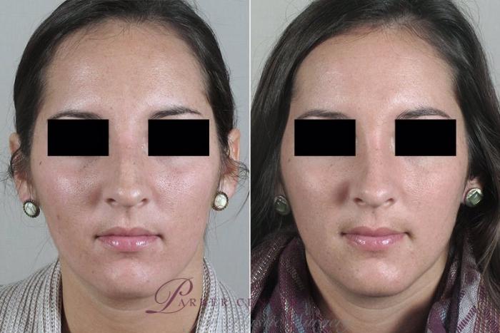 Rhinoplasty Case 177 Before & After View #1 | Paramus, NJ | Parker Center for Plastic Surgery