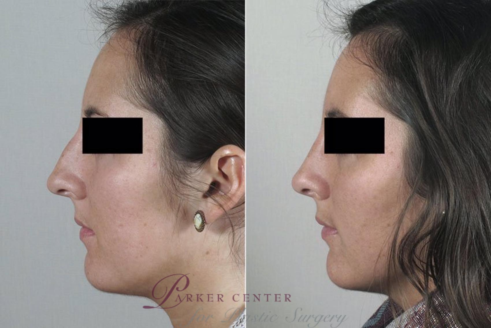 Rhinoplasty Case 177 Before & After View #2 | Paramus, NJ | Parker Center for Plastic Surgery