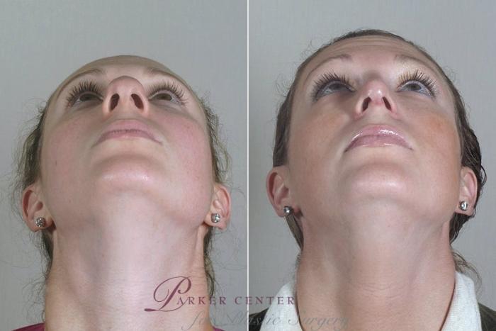 Rhinoplasty Case 178 Before & After View #2 | Paramus, NJ | Parker Center for Plastic Surgery