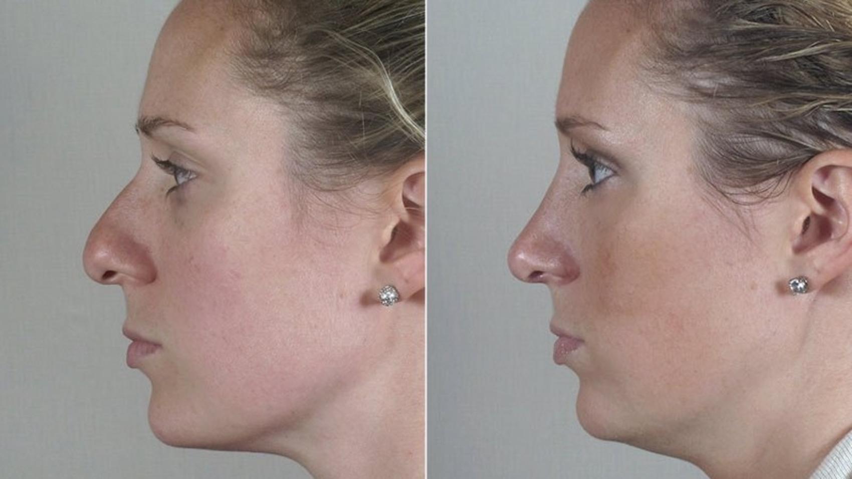 Rhinoplasty Case 178 Before & After View #3 | Paramus, NJ | Parker Center for Plastic Surgery