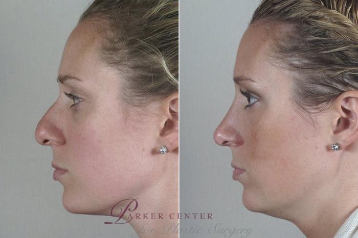 Rhinoplasty Case 178 Before & After View #3 | Paramus, NJ | Parker Center for Plastic Surgery