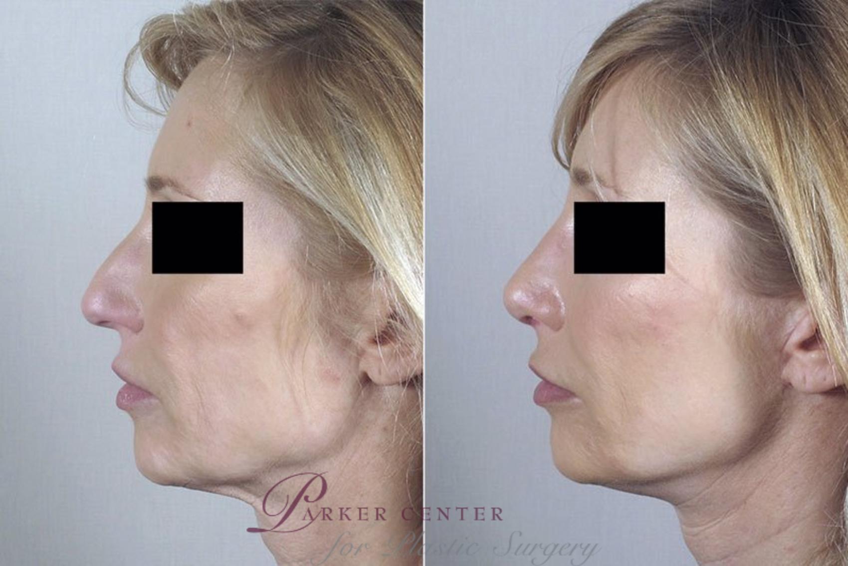 Rhinoplasty Case 179 Before & After View #2 | Paramus, NJ | Parker Center for Plastic Surgery