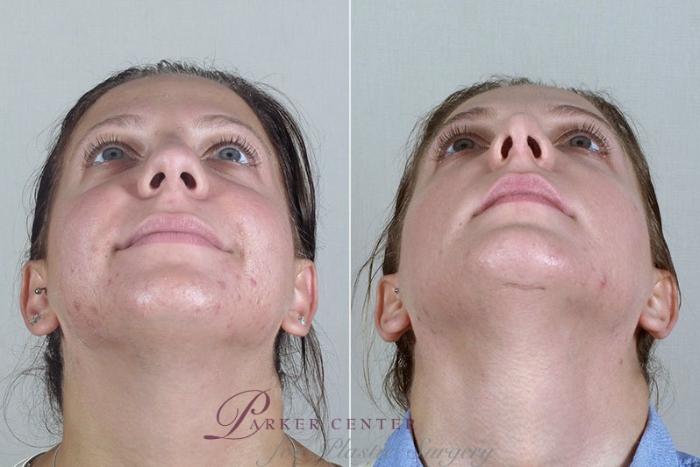 Rhinoplasty Case 180 Before & After View #2 | Paramus, NJ | Parker Center for Plastic Surgery