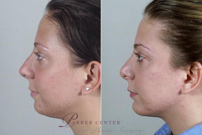 Rhinoplasty Case 180 Before & After View #3 | Paramus, NJ | Parker Center for Plastic Surgery