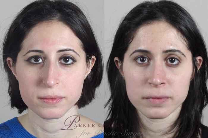 Rhinoplasty Case 181 Before & After View #1 | Paramus, NJ | Parker Center for Plastic Surgery