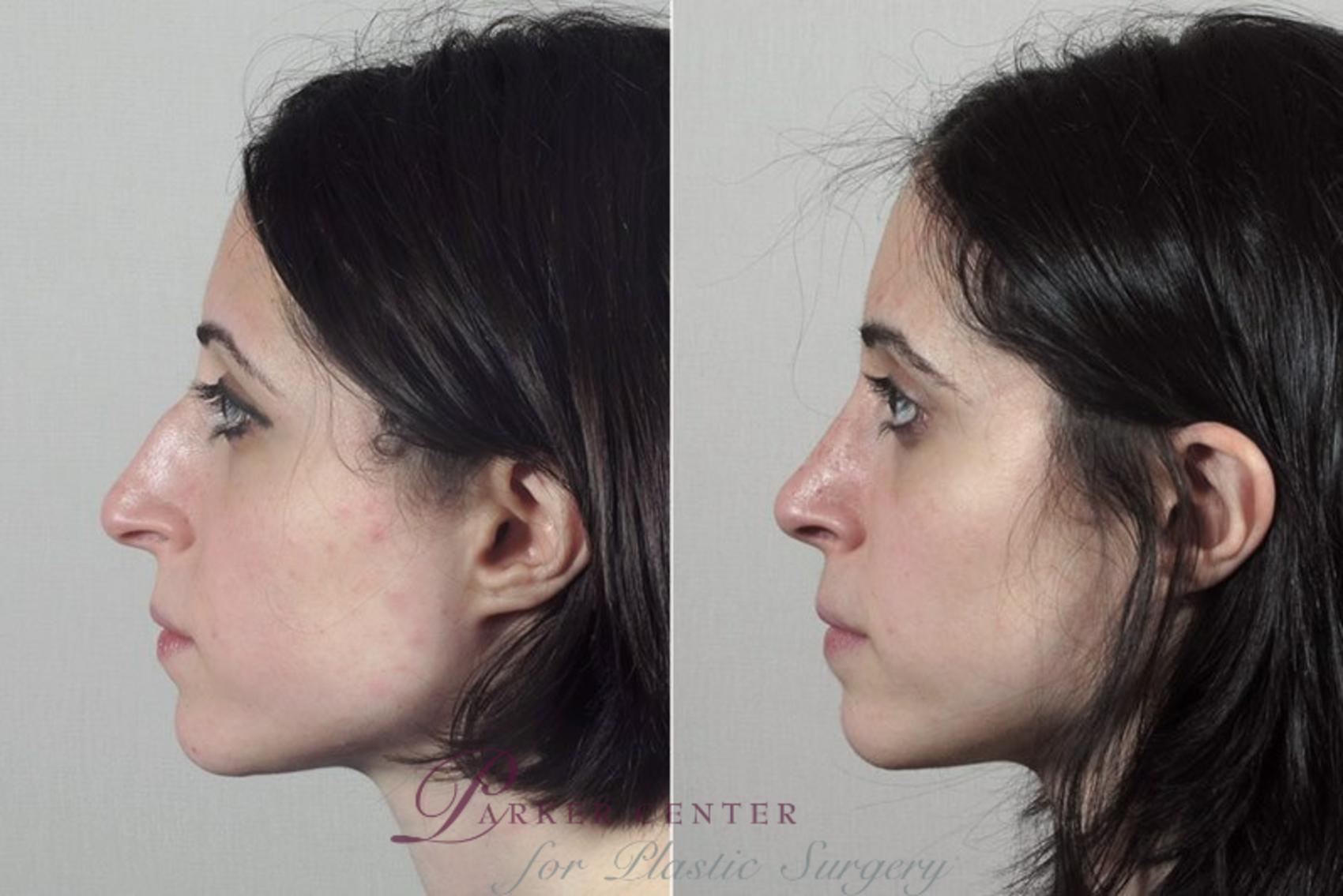 Rhinoplasty Case 181 Before & After View #2 | Paramus, NJ | Parker Center for Plastic Surgery