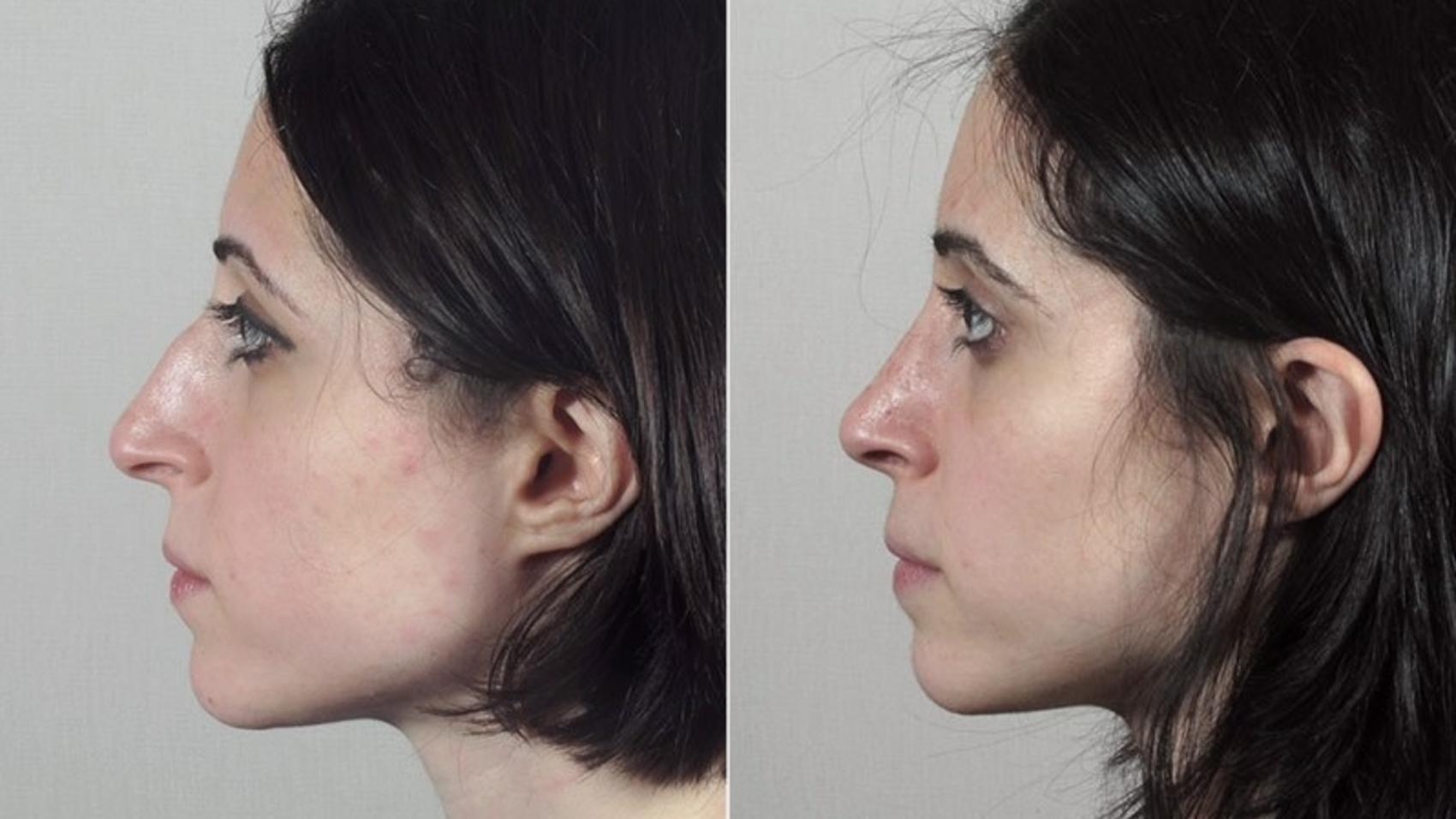 Rhinoplasty Case 181 Before & After View #2 | Paramus, NJ | Parker Center for Plastic Surgery