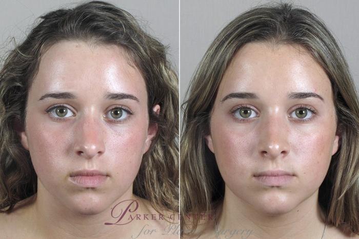 Rhinoplasty Case 182 Before & After View #1 | Paramus, NJ | Parker Center for Plastic Surgery