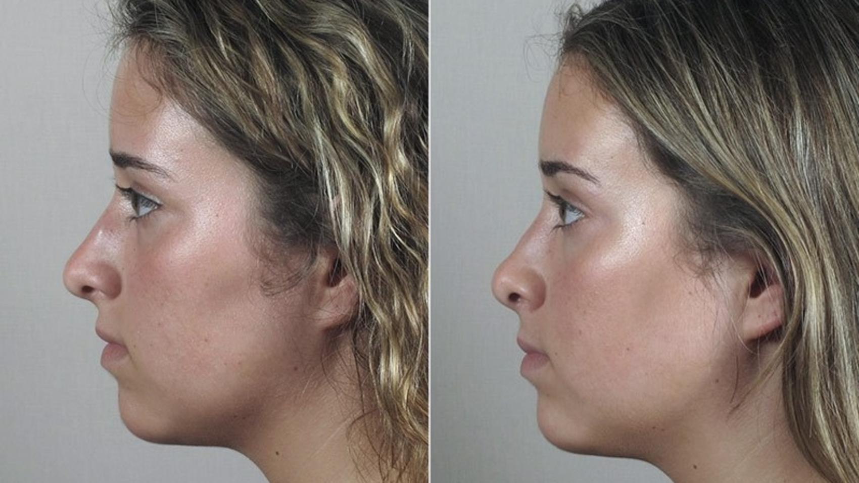 Rhinoplasty Case 182 Before & After View #2 | Paramus, NJ | Parker Center for Plastic Surgery