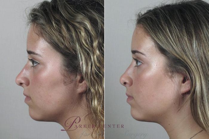 Rhinoplasty Case 182 Before & After View #2 | Paramus, NJ | Parker Center for Plastic Surgery