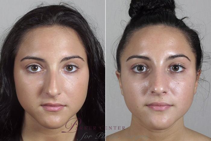 Rhinoplasty Case 183 Before & After View #1 | Paramus, NJ | Parker Center for Plastic Surgery