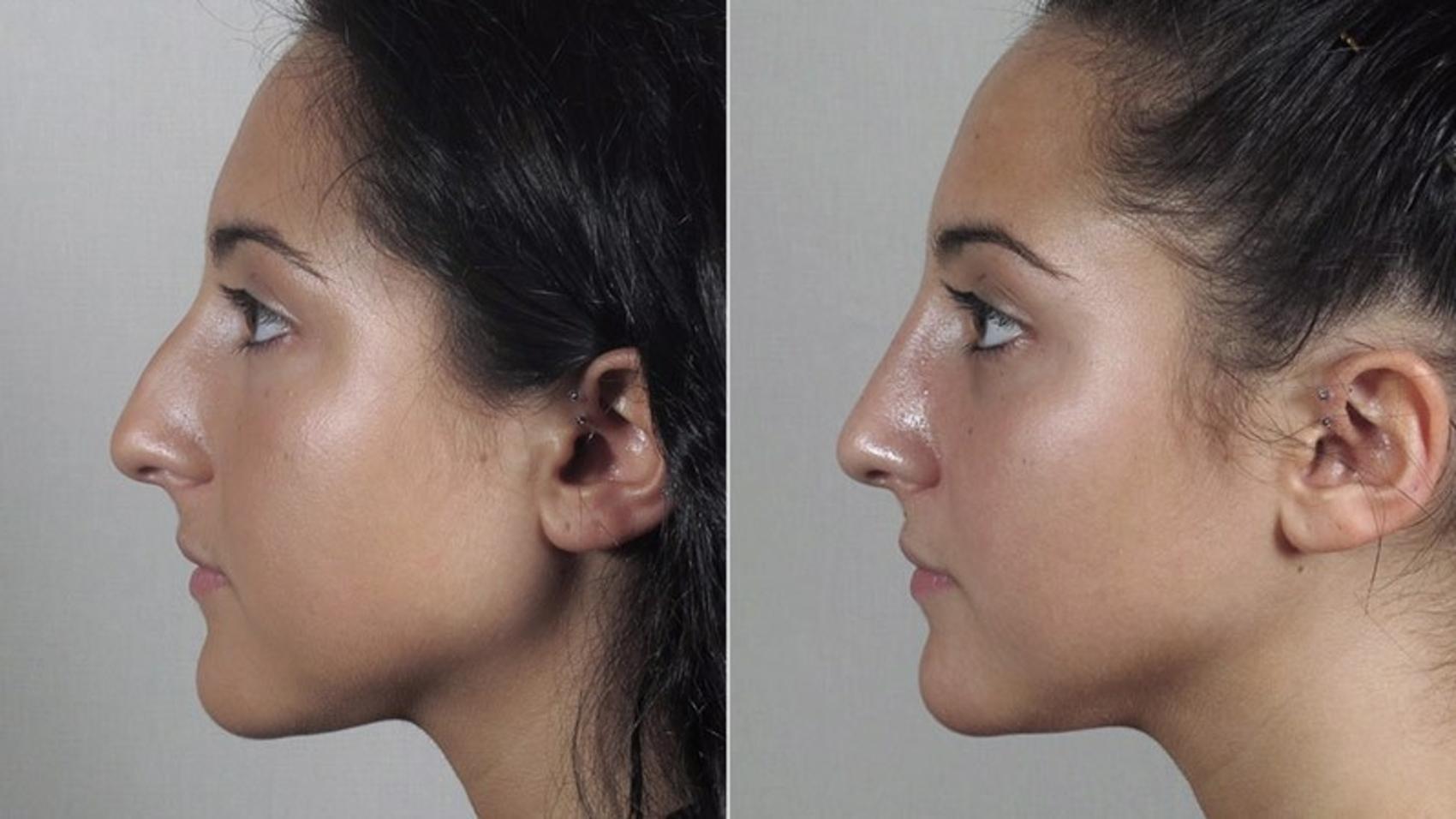 Rhinoplasty Case 183 Before & After View #2 | Paramus, NJ | Parker Center for Plastic Surgery