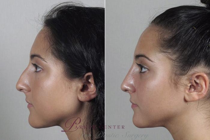 Rhinoplasty Case 183 Before & After View #2 | Paramus, NJ | Parker Center for Plastic Surgery
