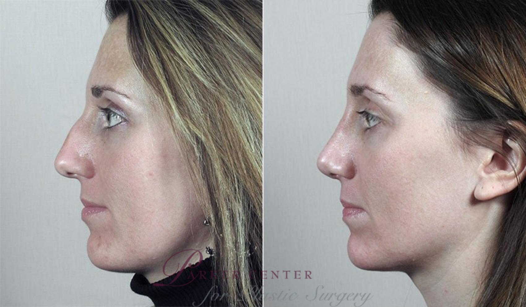 Rhinoplasty Case 185 Before & After View #1 | Paramus, NJ | Parker Center for Plastic Surgery