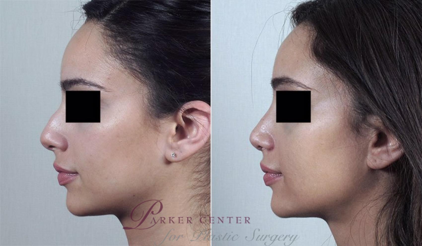 Rhinoplasty Case 186 Before & After View #2 | Paramus, NJ | Parker Center for Plastic Surgery