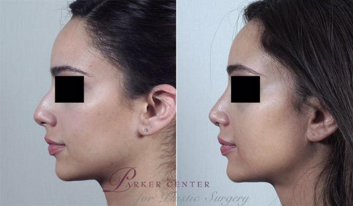 Rhinoplasty Case 186 Before & After View #2 | Paramus, NJ | Parker Center for Plastic Surgery