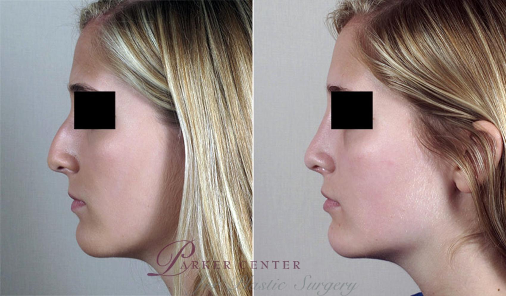 Rhinoplasty Case 187 Before & After View #1 | Paramus, NJ | Parker Center for Plastic Surgery