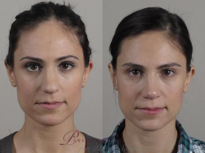 Rhinoplasty Case 189 Before & After Front | Paramus, NJ | Parker Center for Plastic Surgery