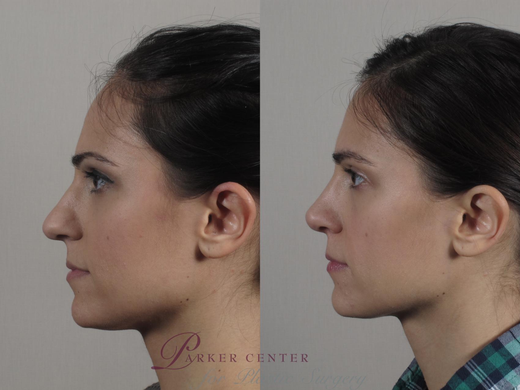 Rhinoplasty Case 189 Before & After Right Side | Paramus, NJ | Parker Center for Plastic Surgery
