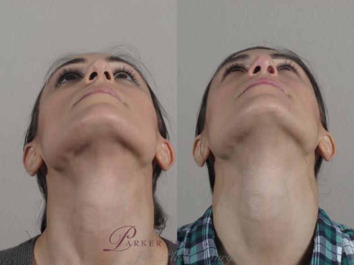 Rhinoplasty Case 189 Before & After Worms eye | Paramus, NJ | Parker Center for Plastic Surgery