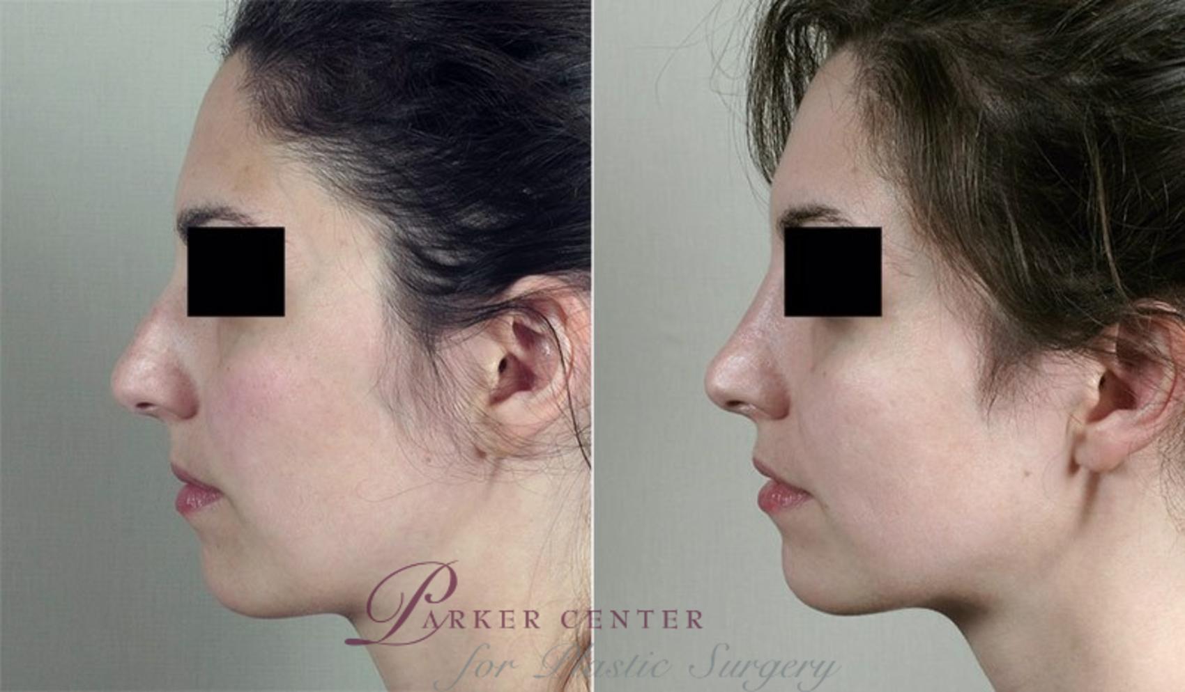 Rhinoplasty Case 190 Before & After View #1 | Paramus, NJ | Parker Center for Plastic Surgery
