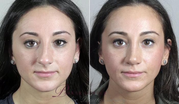Rhinoplasty Case 191 Before & After View #1 | Paramus, NJ | Parker Center for Plastic Surgery