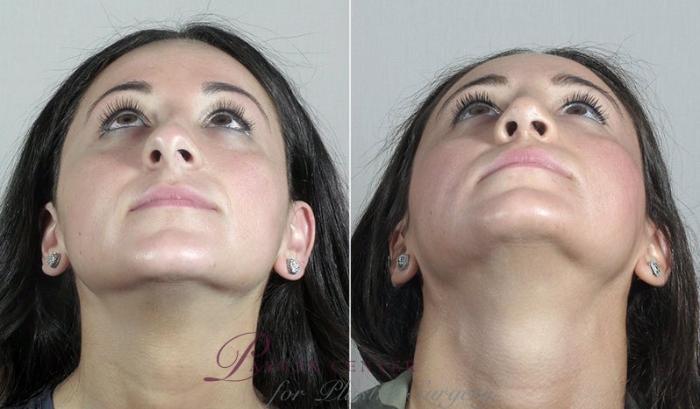 Rhinoplasty Case 191 Before & After View #3 | Paramus, NJ | Parker Center for Plastic Surgery
