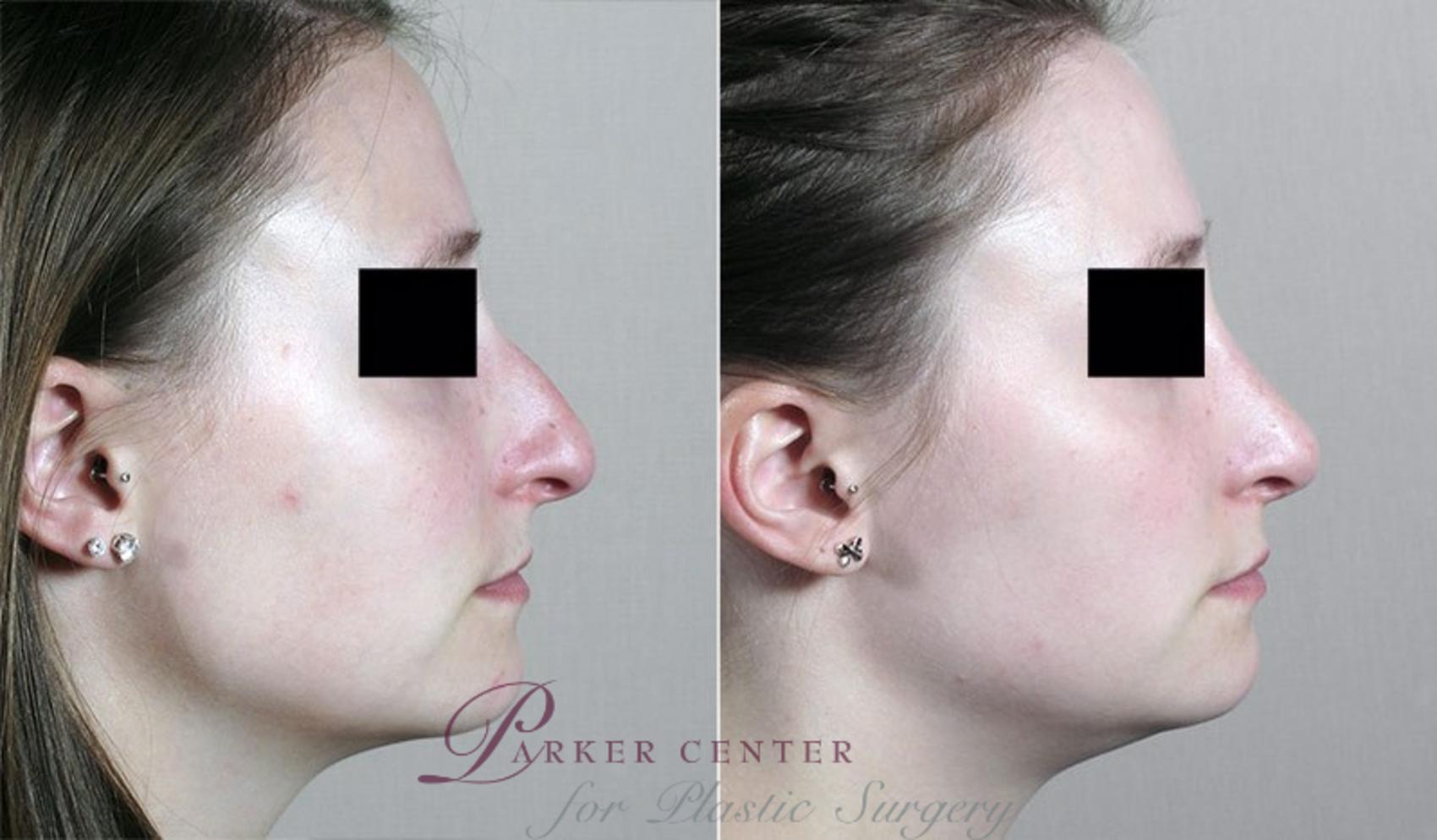 Rhinoplasty Case 192 Before & After View #1 | Paramus, NJ | Parker Center for Plastic Surgery