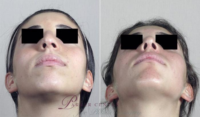 Rhinoplasty Case 193 Before & After View #1 | Paramus, NJ | Parker Center for Plastic Surgery