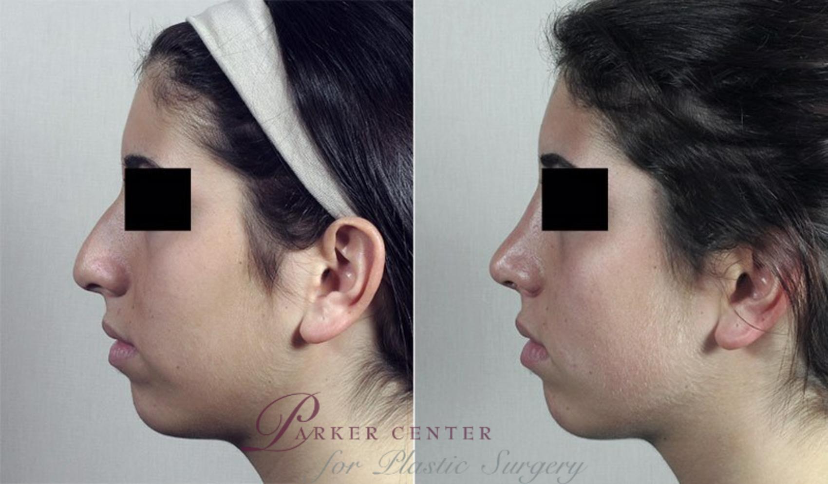 Rhinoplasty Case 193 Before & After View #2 | Paramus, NJ | Parker Center for Plastic Surgery