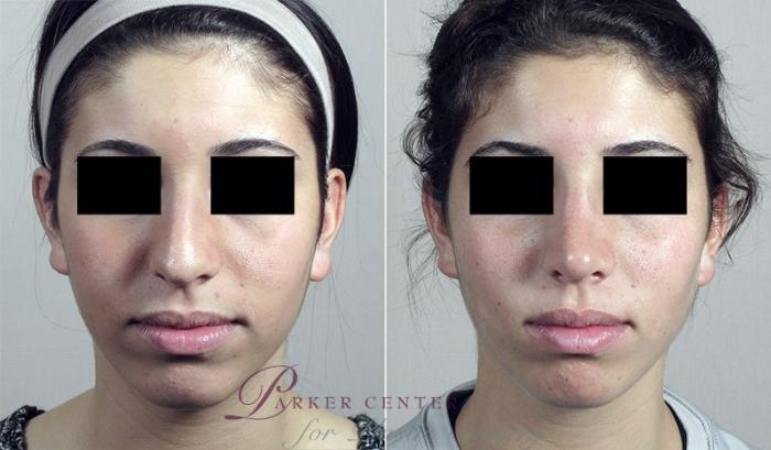 Rhinoplasty Case 193 Before & After View #3 | Paramus, NJ | Parker Center for Plastic Surgery