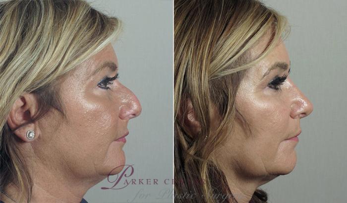 Rhinoplasty Case 194 Before & After View #2 | Paramus, NJ | Parker Center for Plastic Surgery