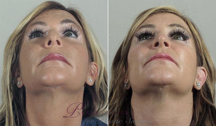 Rhinoplasty Case 194 Before & After View #3 | Paramus, NJ | Parker Center for Plastic Surgery