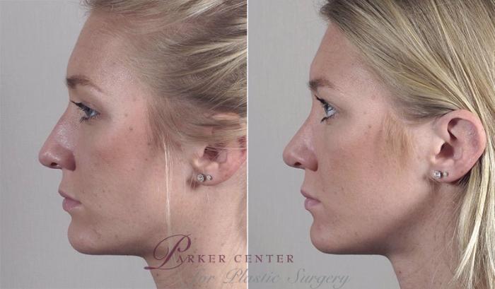 Rhinoplasty Case 195 Before & After View #1 | Paramus, NJ | Parker Center for Plastic Surgery