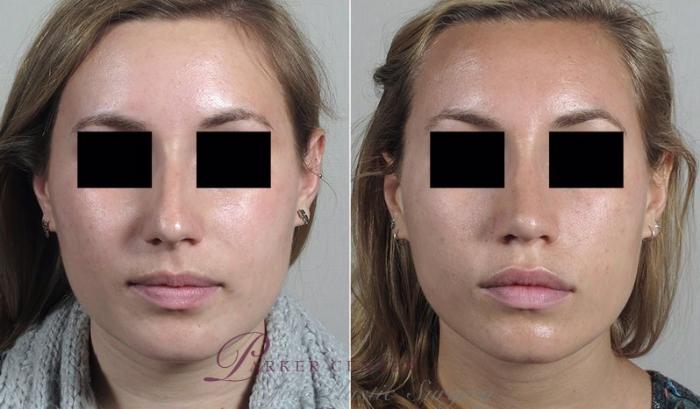 Rhinoplasty Case 196 Before & After View #1 | Paramus, NJ | Parker Center for Plastic Surgery