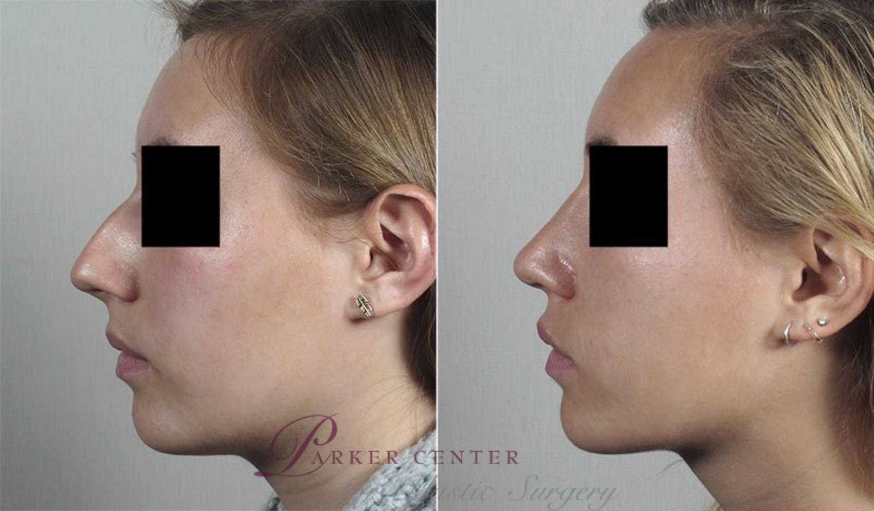 Rhinoplasty Case 196 Before & After View #2 | Paramus, NJ | Parker Center for Plastic Surgery