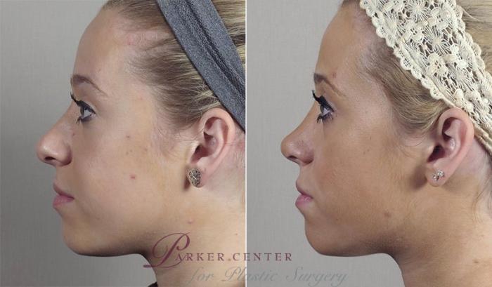 Rhinoplasty Case 197 Before & After View #1 | Paramus, NJ | Parker Center for Plastic Surgery