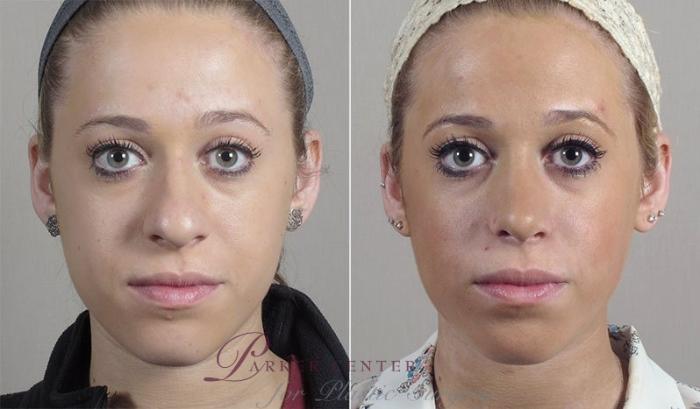 Rhinoplasty Case 197 Before & After View #2 | Paramus, NJ | Parker Center for Plastic Surgery
