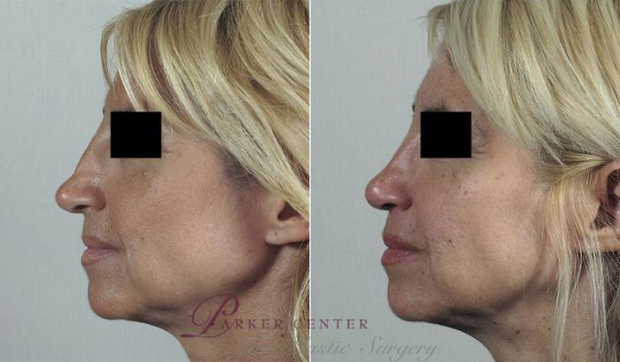 Rhinoplasty Case 198 Before & After View #2 | Paramus, NJ | Parker Center for Plastic Surgery