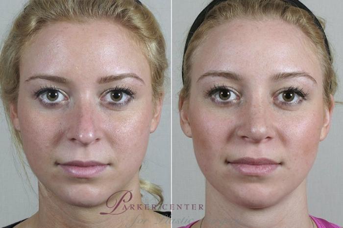 Rhinoplasty Case 199 Before & After View #1 | Paramus, NJ | Parker Center for Plastic Surgery