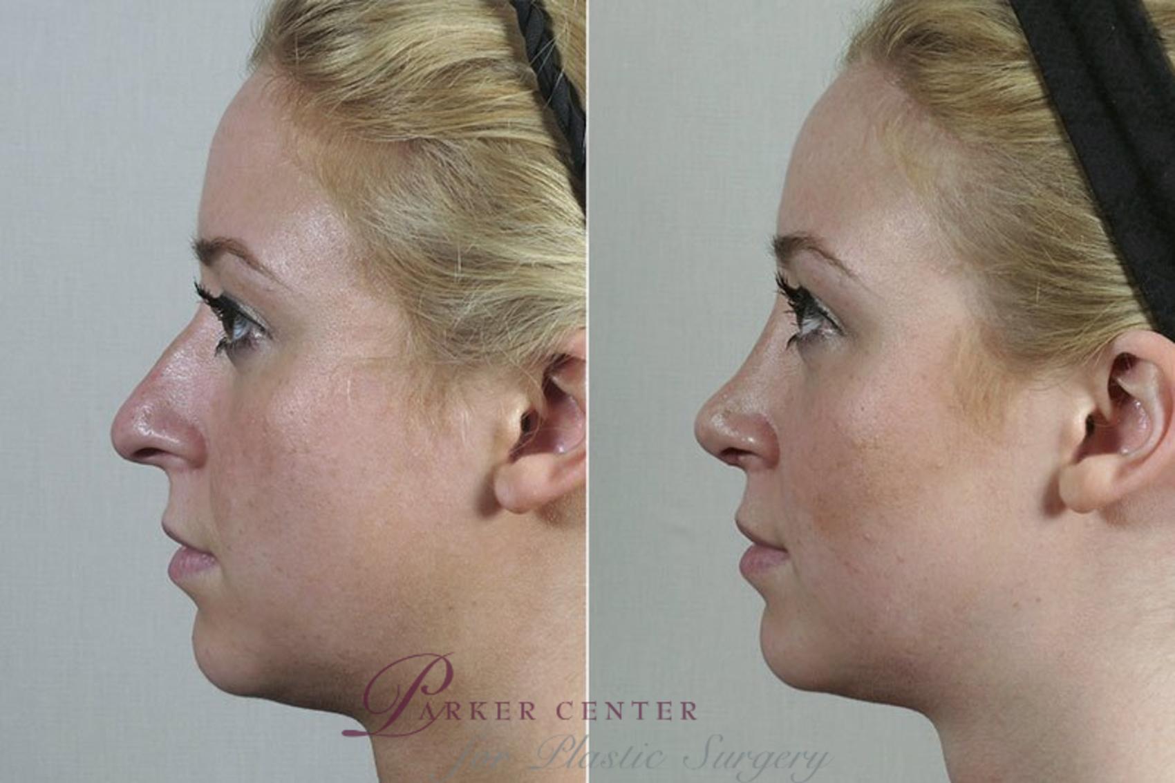 Rhinoplasty Case 199 Before & After View #2 | Paramus, NJ | Parker Center for Plastic Surgery