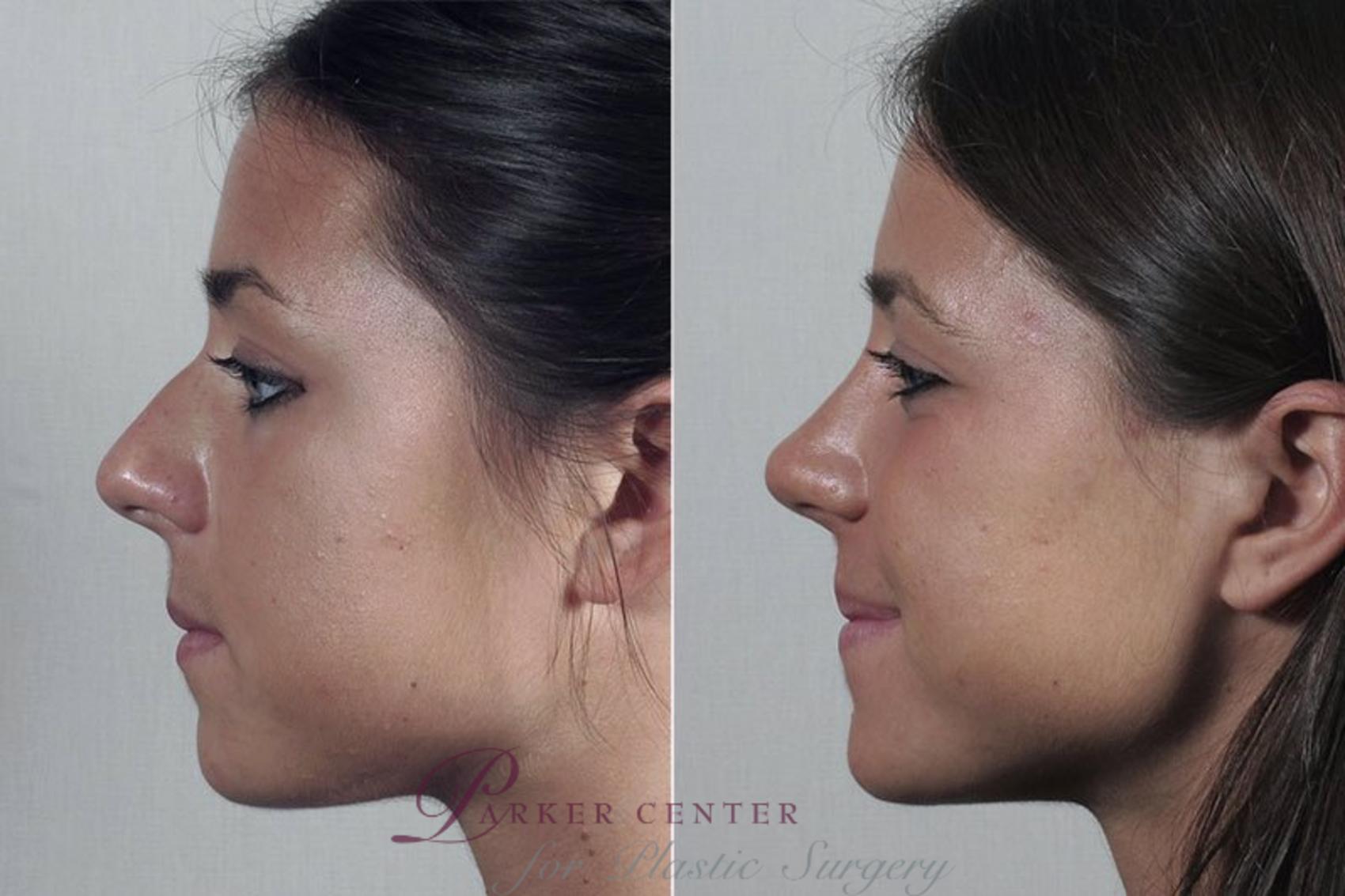 Rhinoplasty Case 200 Before & After View #2 | Paramus, NJ | Parker Center for Plastic Surgery