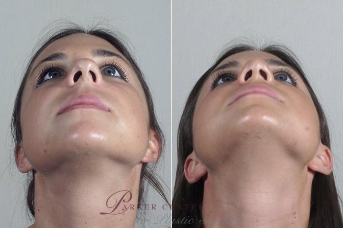 Rhinoplasty Case 200 Before & After View #3 | Paramus, NJ | Parker Center for Plastic Surgery