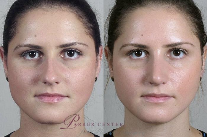 Rhinoplasty Case 201 Before & After View #1 | Paramus, New Jersey | Parker Center for Plastic Surgery