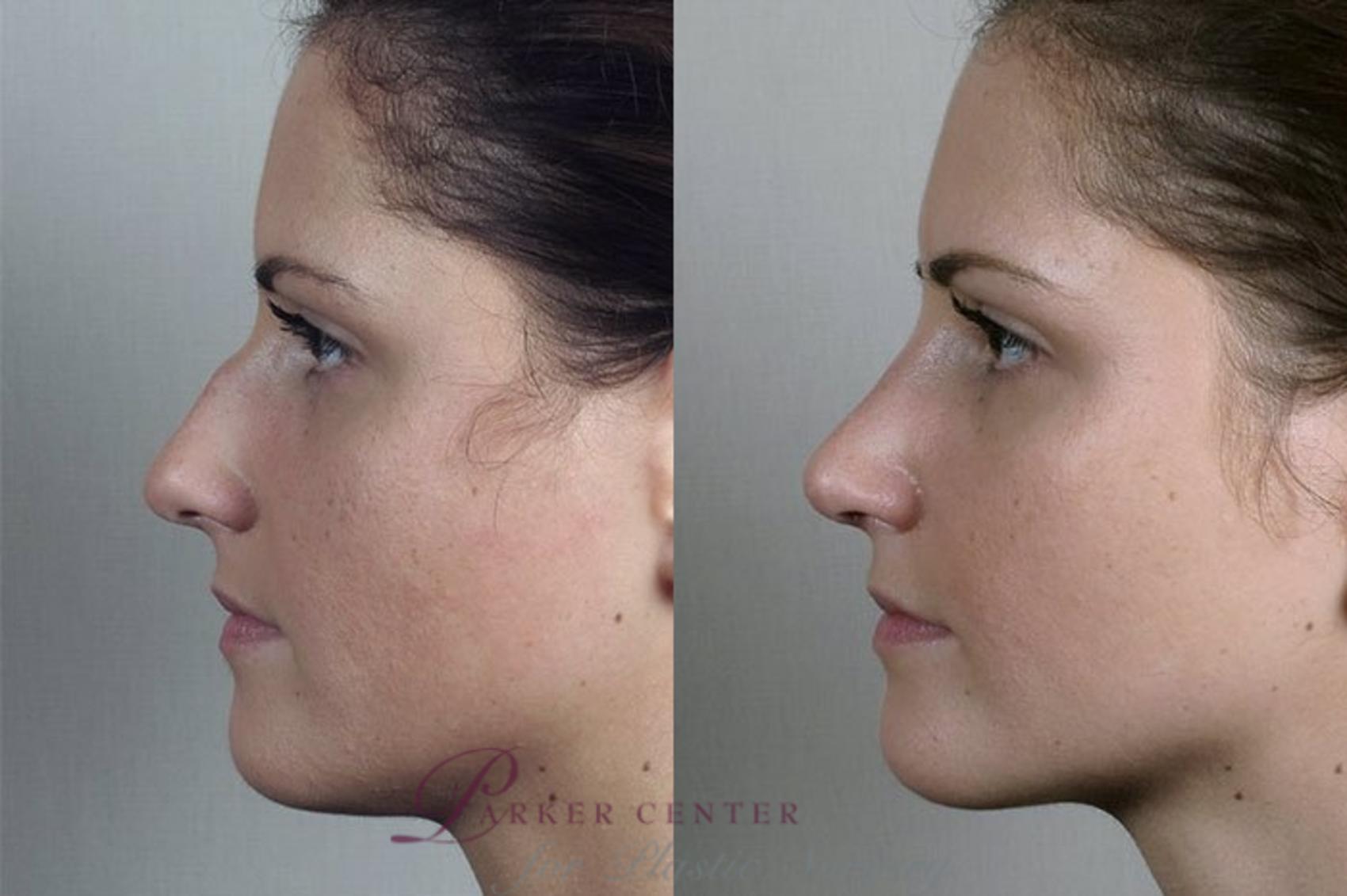 Rhinoplasty Case 201 Before & After View #2 | Paramus, NJ | Parker Center for Plastic Surgery