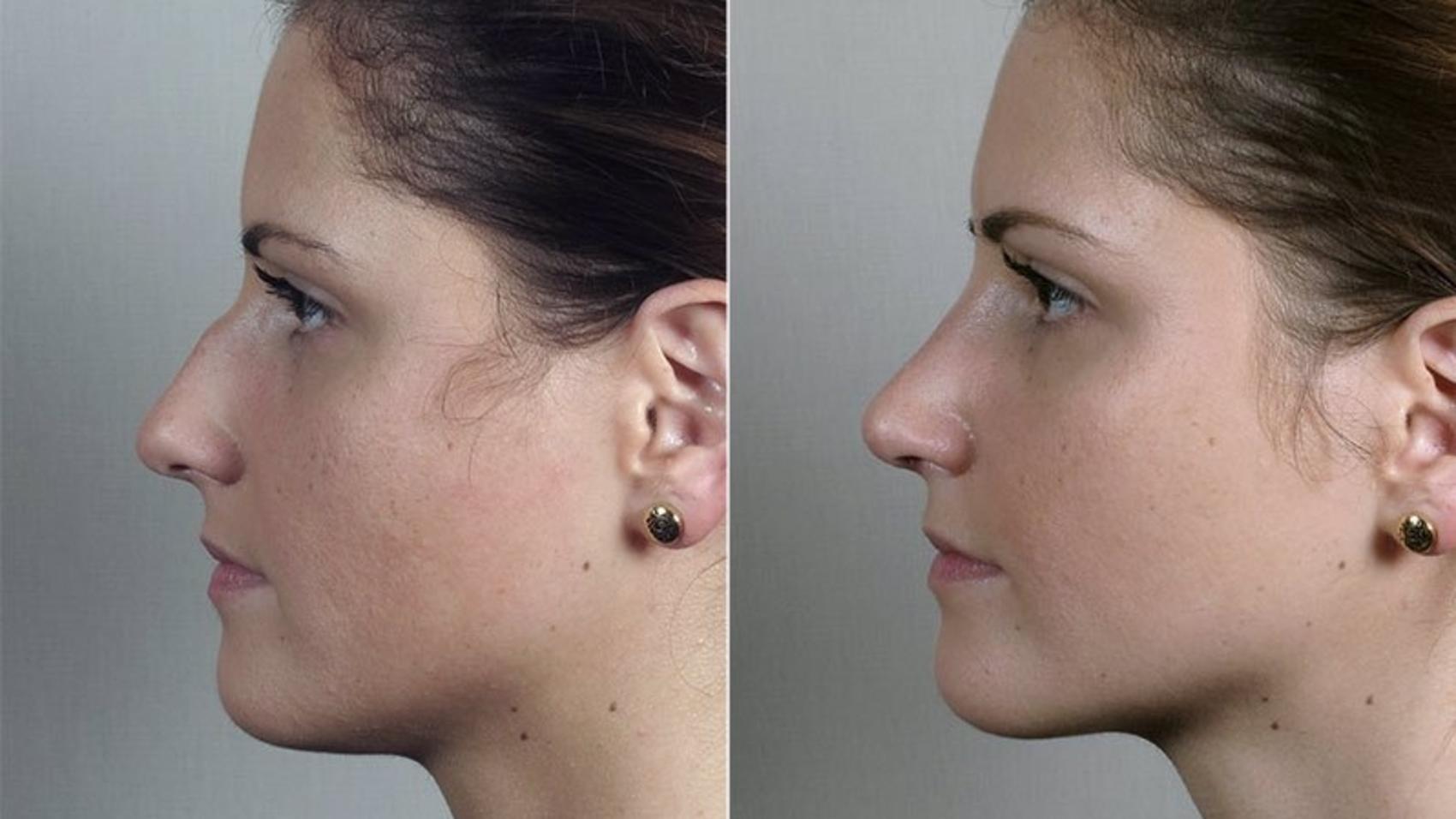 Rhinoplasty Case 201 Before & After View #2 | Paramus, New Jersey | Parker Center for Plastic Surgery